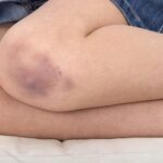 Simple Tricks On How to Get Rid of Bruises With Toothpaste ⋆ BeautyNews