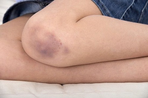 Simple Tricks On How to Get Rid of Bruises With Toothpaste ⋆ BeautyNews