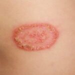 How To Get Rid Of Ringworm With Bleach ⋆ BeautyNews