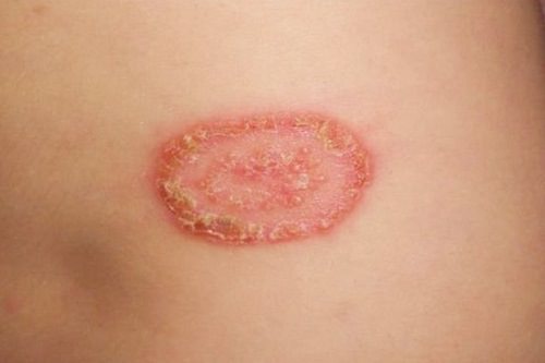 How To Get Rid Of Ringworm With Bleach ⋆ BeautyNews