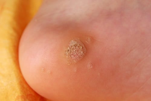 Does Dandelion Milk Get Rid of Warts? Is it Safe? ⋆ BeautyNews