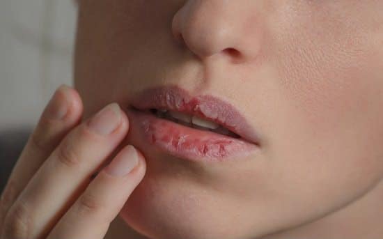 10 Best Essential Oils For Chapped Lips ⋆ BeautyNews