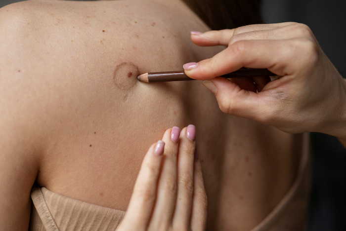 How to Heal Smart After Skin Cancer Surgery