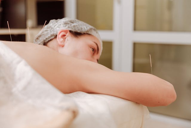 Top 10 benefits of acupuncture