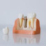 Which factors influence the costs of dental implants in the UK?