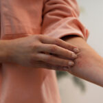 Eczema Skin Barrier: Fewer Good Bugs Mean Weaker Protection