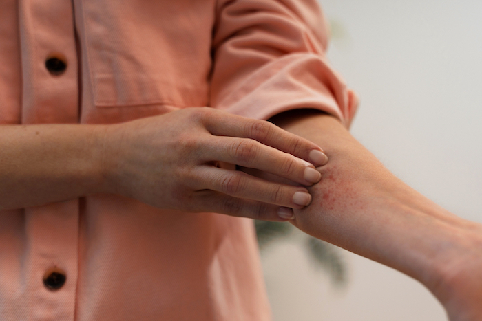 Eczema Skin Barrier: Fewer Good Bugs Mean Weaker Protection