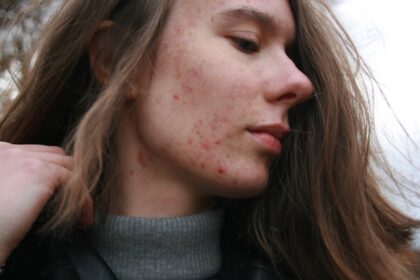 Understanding How It May Help With Acne
