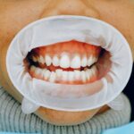 Can You Whiten Teeth If You Have Gum Recession?