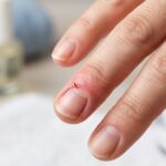 Hangnail infections: how to treat and prevent them