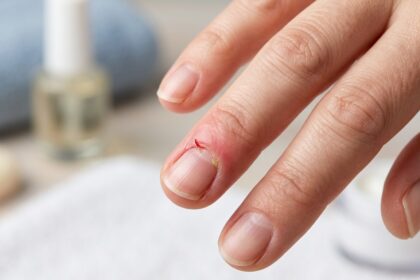 Hangnail infections: how to treat and prevent them