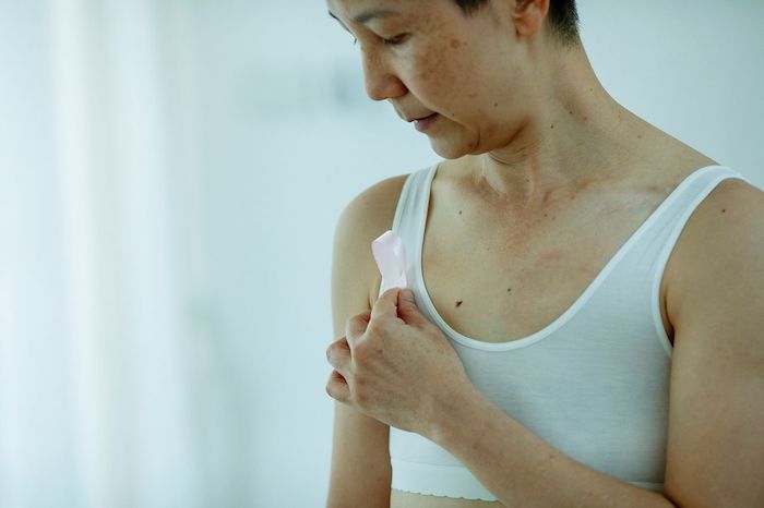Radiation Dermatitis After Treatment: Why Your Skin May Get Worse Before It Gets Better